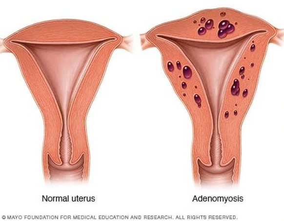 ендометріоз akusher ginekolog