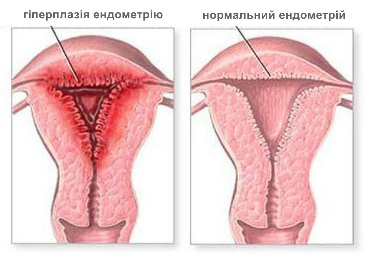 Гіперплазія ендометрію Гіперплазія ендометрію akusher ginekolog com ua