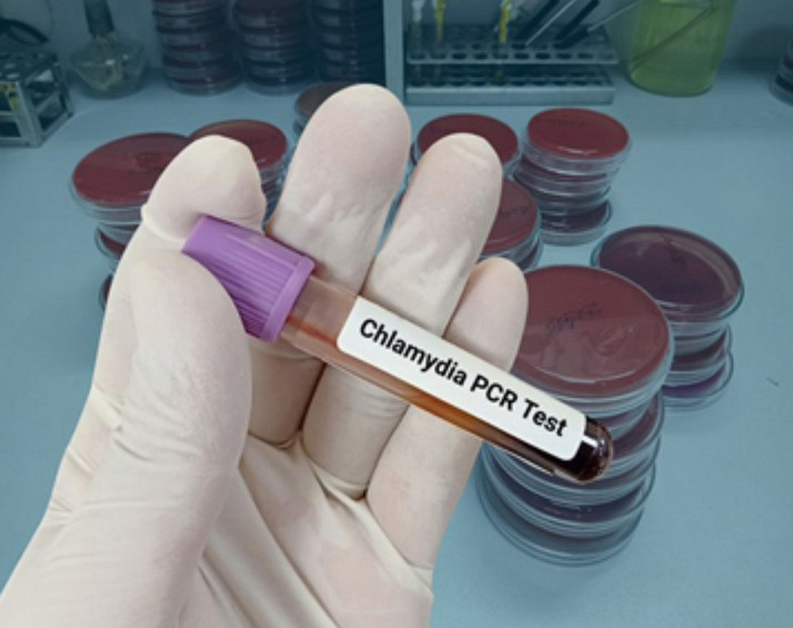 хламідіоз akusher ginekolog com ua