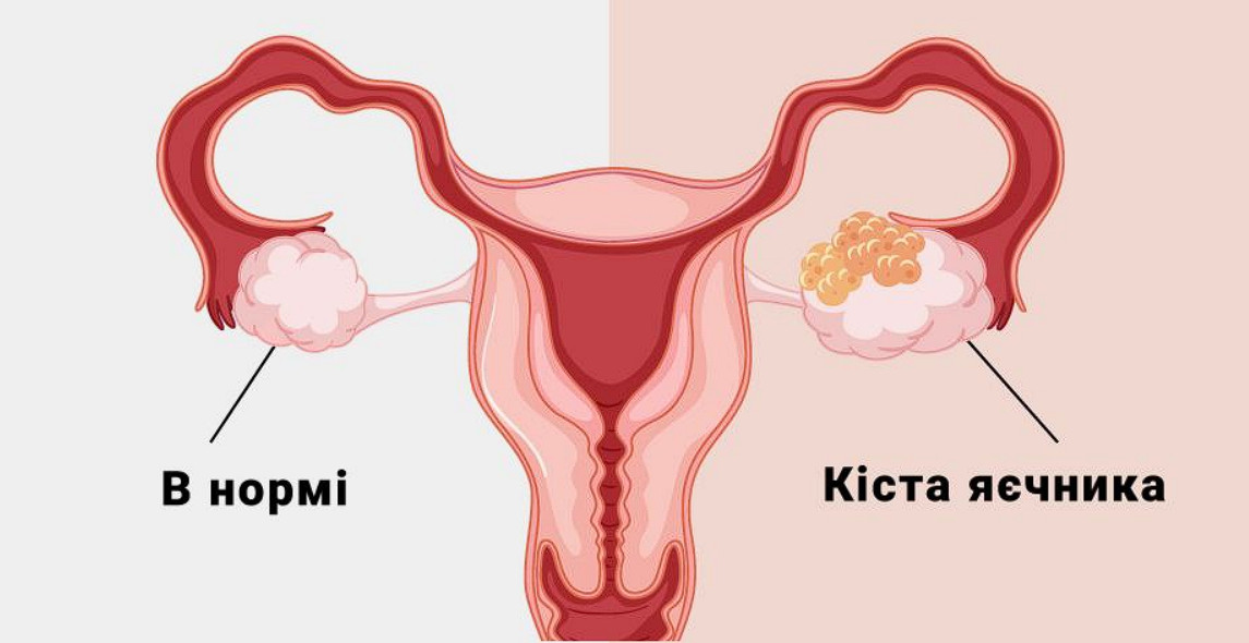 Кіста жовтого тілаakusher ginekolog com ua