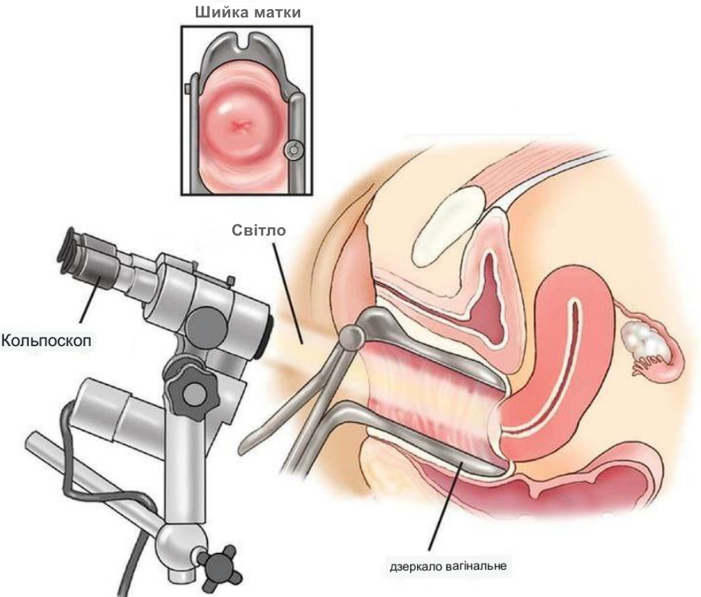 kolposkopiya2 akusher ginekolog com ua kolposkopiya2 akusher ginekolog com ua