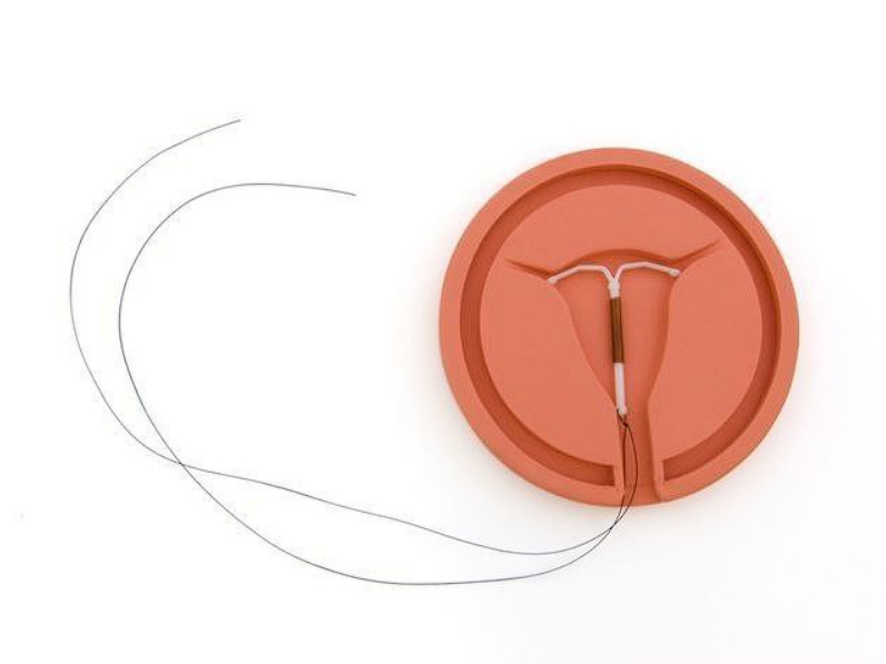 kontracepciya vnutrishno matkova spiral akusher ginekolog com ua