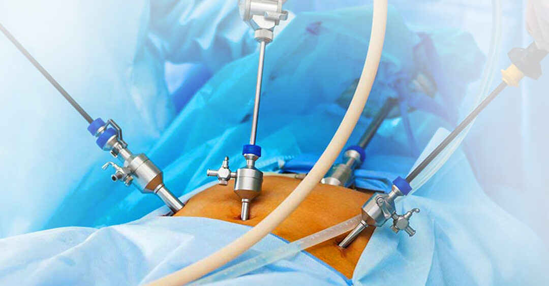 Лапароскопія в гінекології