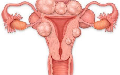 Міомектомія