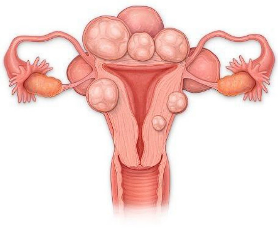 Міомектомія