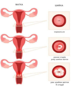 Рак шийки матки