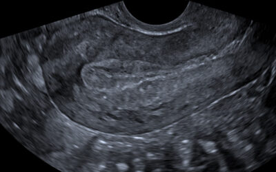 УЗД органів малого тазу (жіночих статевих органів)