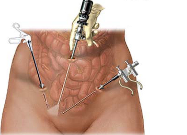 Фіброміома матки (лейоміома, міома матки) akusher ginekolog com ua
