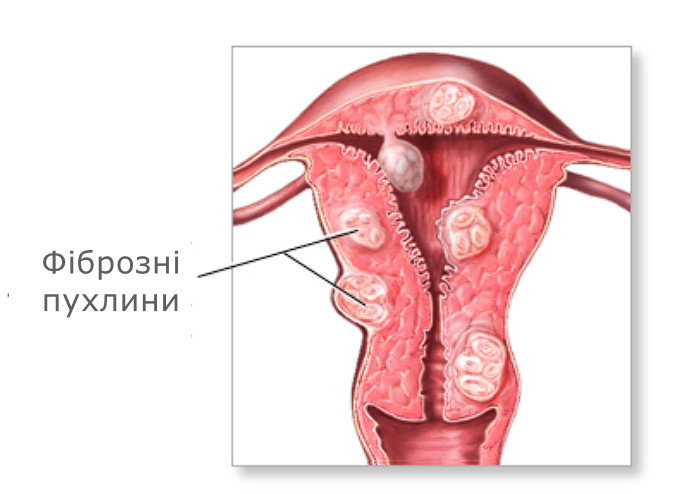 fibromioma matky akusher ginekolog com ua