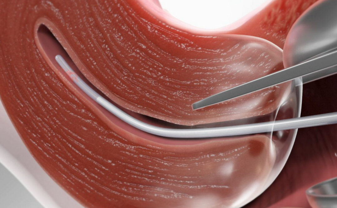 Біопсія матки akusher ginekolog com ua