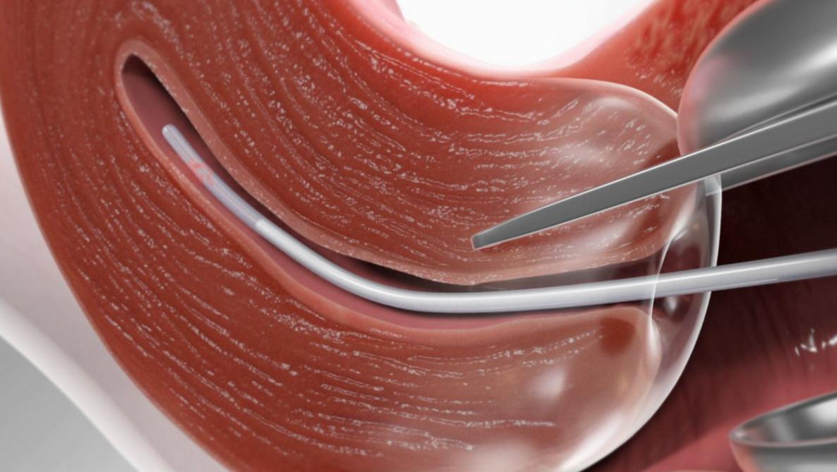 Біопсія матки akusher ginekolog com ua