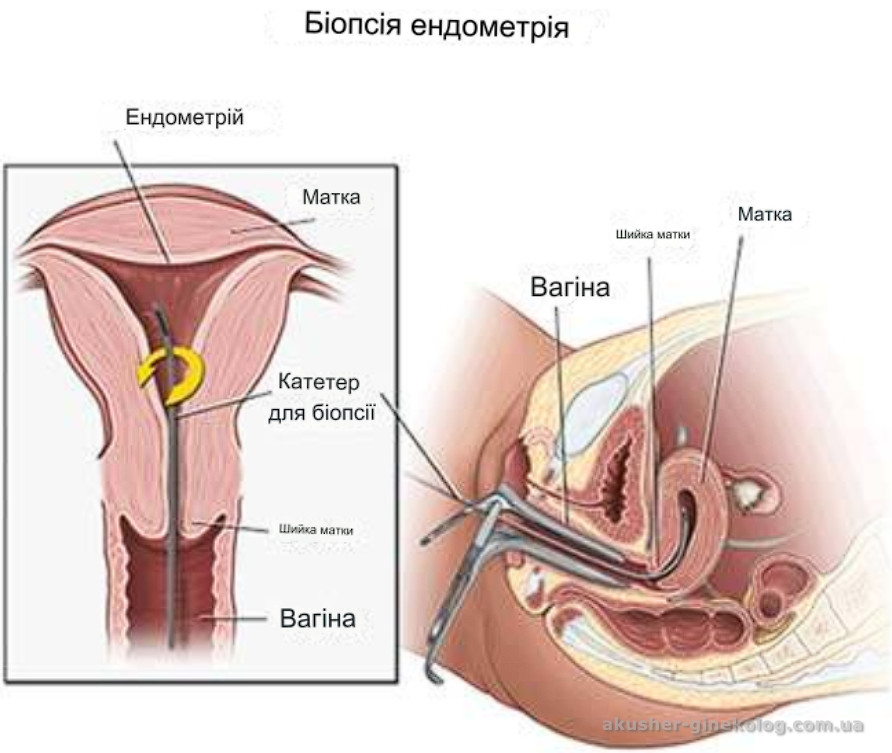 biopsija matky infografika akusher ginekolog com ua