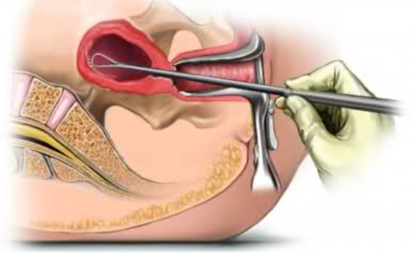Біопсія шийки матки akusher ginekolog com ua