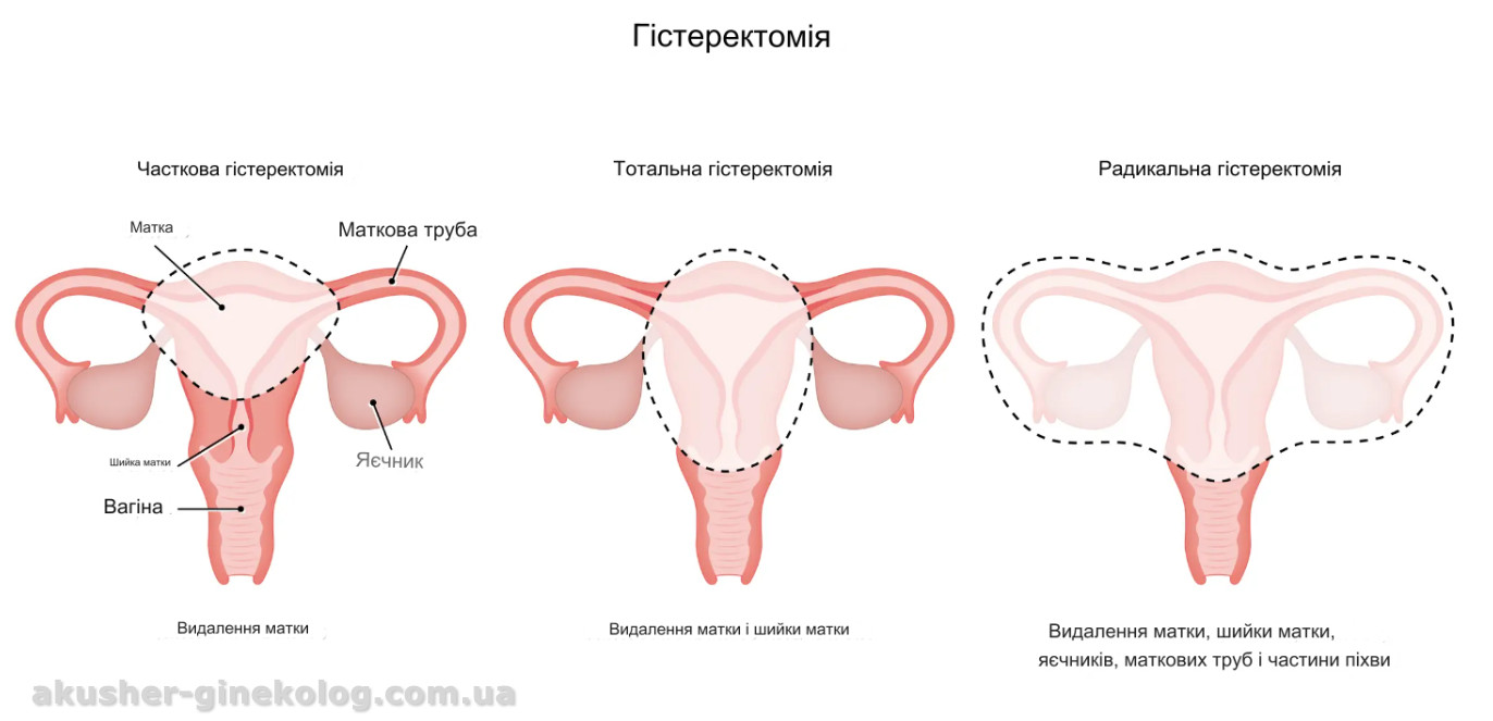 гістеректомія види akusher ginekolog com ua