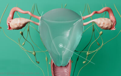 Гістеректомія: що варто знати про операцію