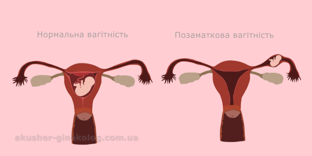 Позаматкова вагітність akusher ginekolog com ua