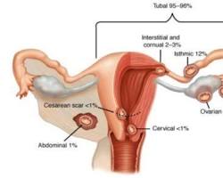 Зображення: Позаматкова вагітність