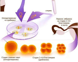 Зображення: ЕКЗ процедура