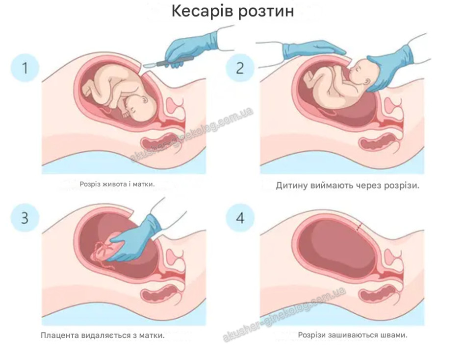 хірургічна операція кесаревого розтину akusher ginekolog com ua