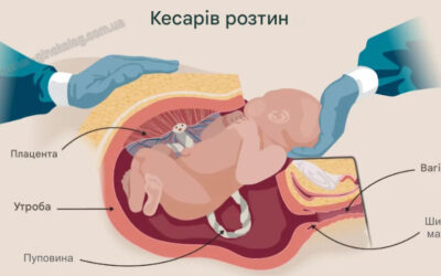 Кесарів розтин: Показання, підготовка, процедура, відновлення