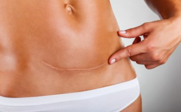 Кесарів розтин шрам на животі akusher ginekolog com ua