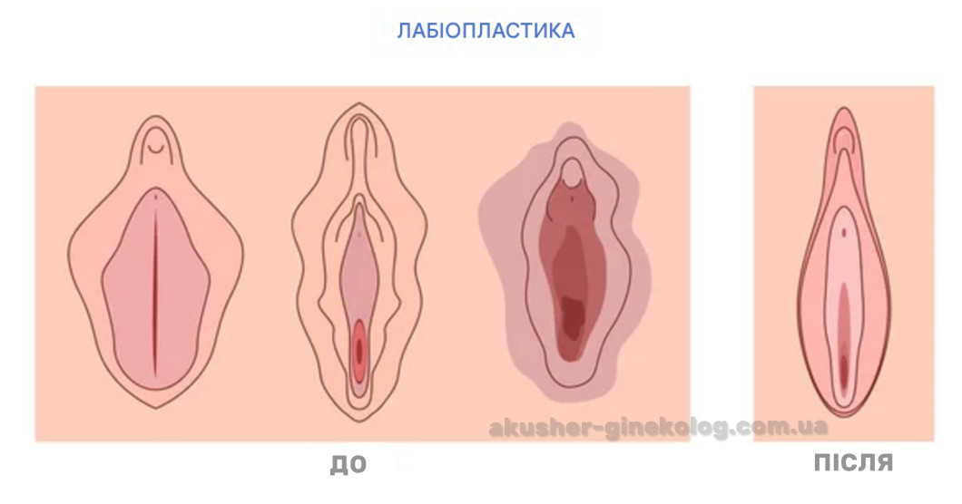 лабіопластика статевих губ лабіопластика до і після, результат змін, "фото" ginekolog com ua
