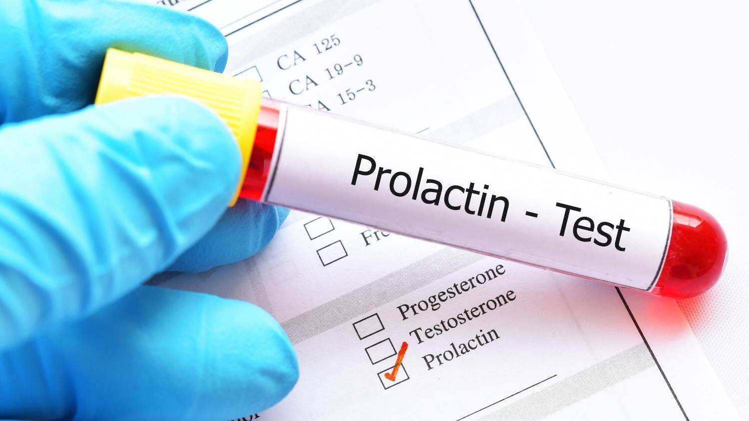 Результати аназізу на пролактін