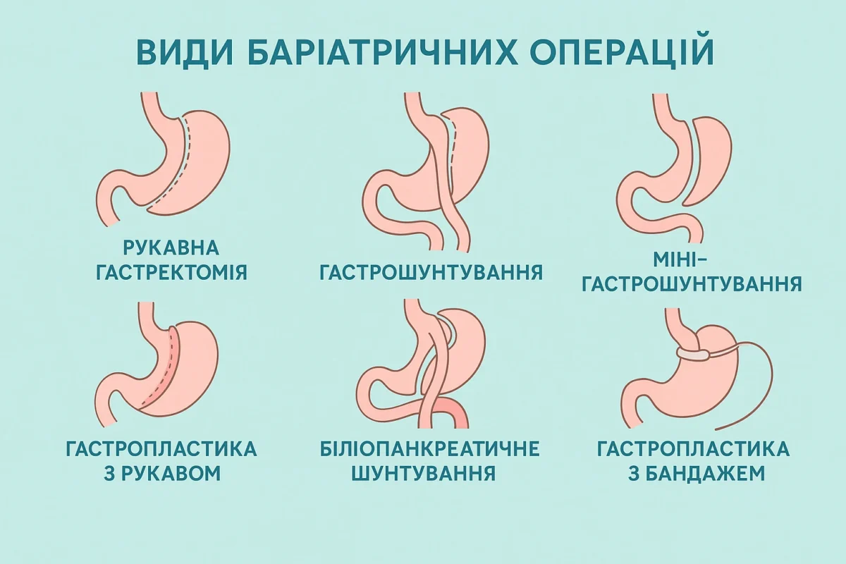 Баріатричні операції Емір Усеінов Таір